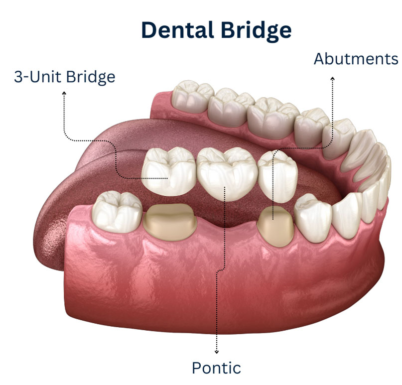 Dental Bridge