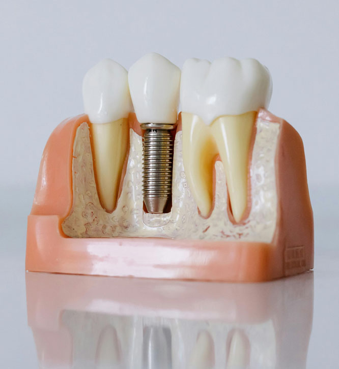 Bone Grafting and Dental Implant