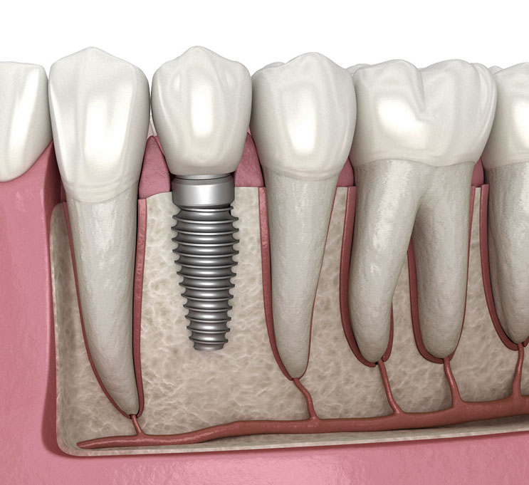 Dental Implant